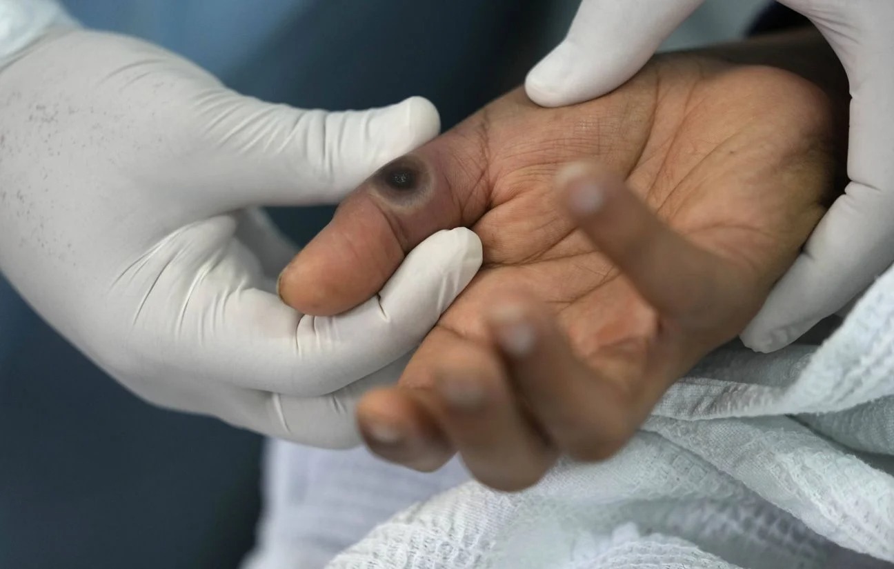 Le Burundi enregistre des progrès significatifs dans la lutte contre la mpox