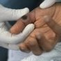 Le Burundi enregistre des progrès significatifs dans la lutte contre la mpox